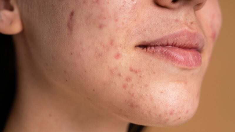 Os 4 Melhores Anticoncepcionais para Combater a Acne