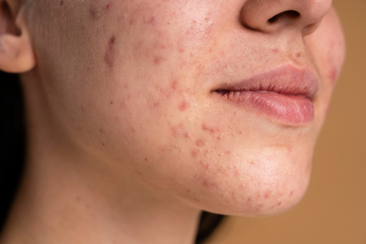 Os 4 Melhores Anticoncepcionais para Combater a Acne